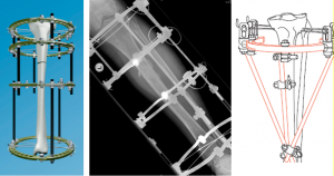 Séminaire de traumatologie AOA—Traitement des pertes de substance osseuse post fracturaires. Travaux pratiques : Fixateur externe d´Ilizarov